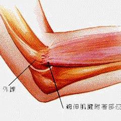 網球癥怎么治療最好（網球肘的最佳治療方法，別錯過最佳的康復時間，記得關注收藏！）
