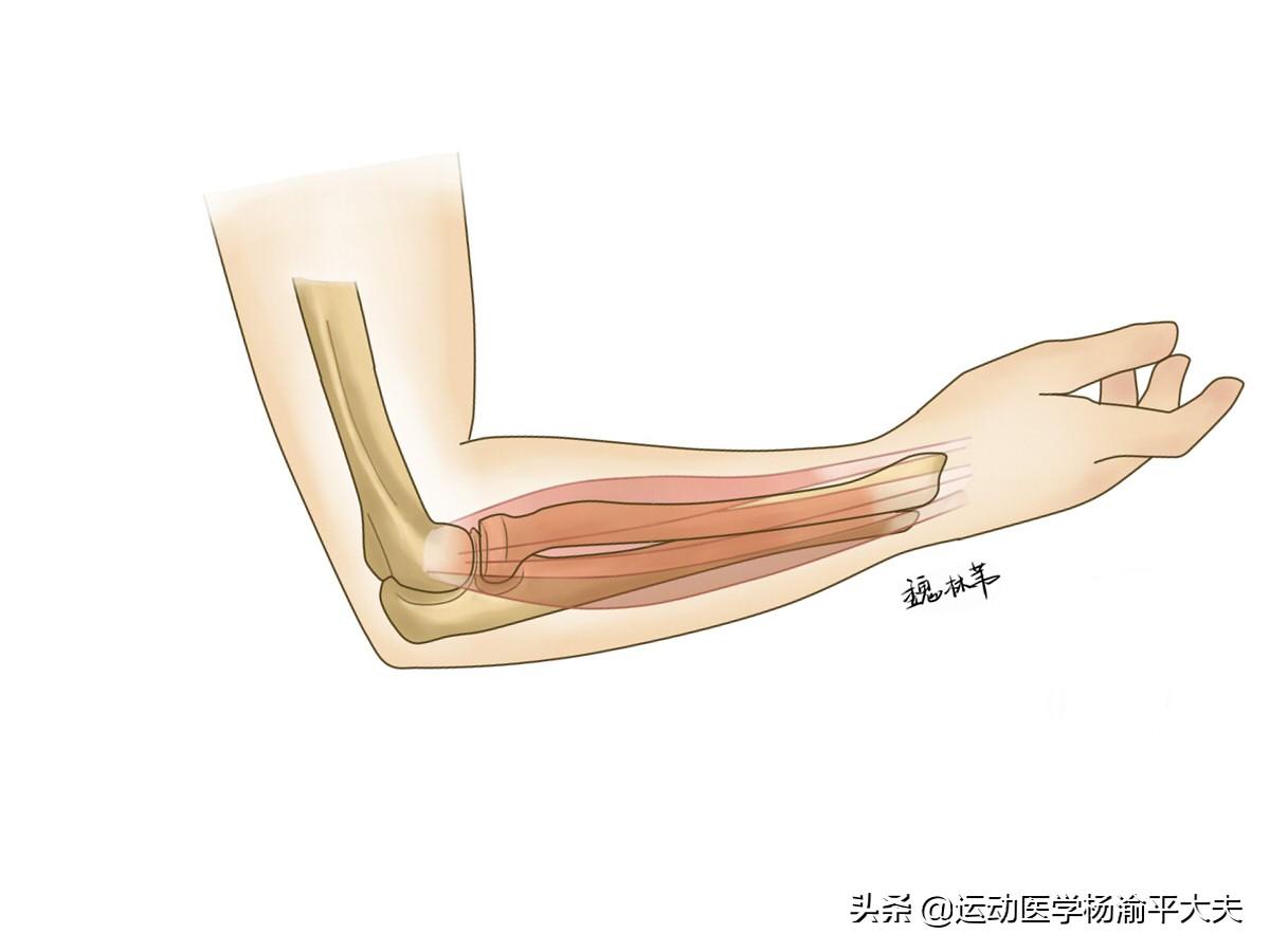 網球癥怎么治療最好（什么是治療網球肘有效辦法？這五個動作助你康復事半功倍）